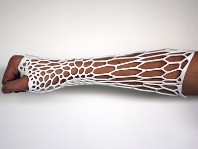 骨折也能很時尚！Cortex cast 3D列印，提供病人更輕、通風、易洗、更時尚的固定方案