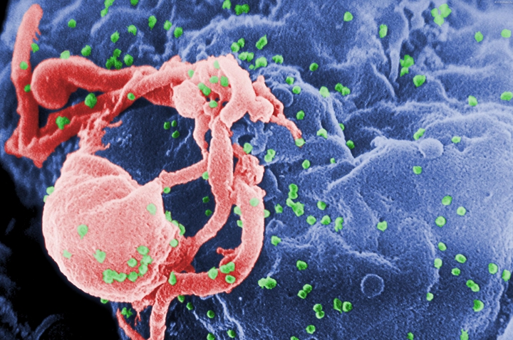 愛滋病有望治癒?法國科學家成功摧毀感染HIV病毒細胞